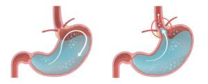 Diagram: Gastroezofageálny reflux u dojčiat