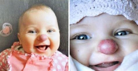 Dieťa s upchatým nosom