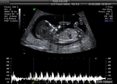 Ultrazvukové zobrazenie molárneho tehotenstva