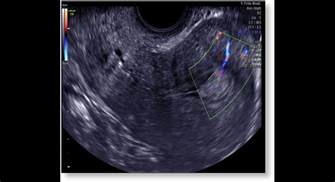 Ultrazvukové zobrazenie myómov maternice