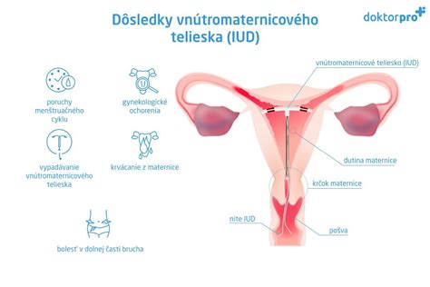 Diagram vnútromaternicového telieska Mirena
