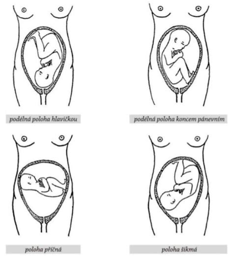 Diagram zobrazujúci rôzne polohy plodu v maternici počas pôrodu