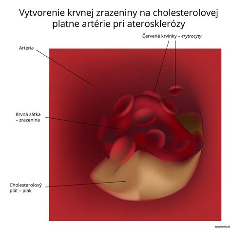Ilustrácia krvnej zrazeniny v cievi