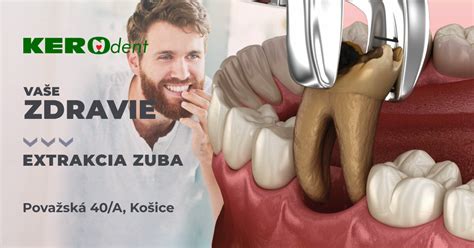 Ilustrácia zuba v zubnom lôžku