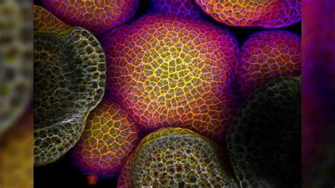 Mikroskopický pohľad na rakovinové bunky