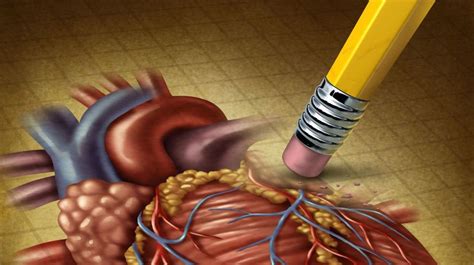 Ilustrácia znázorňujúca proces odberu a transplantácie srdca