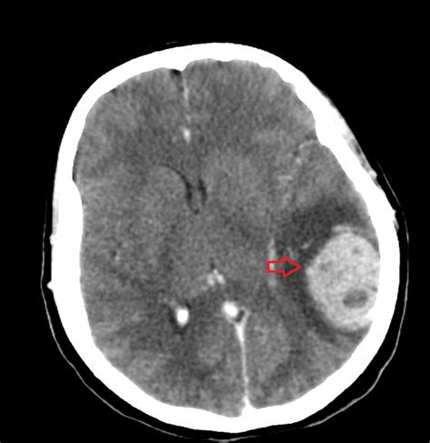 Schematické znázornenie neurotransmiterov v mozgu