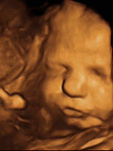 3D ultrazvukové zobrazenie plodu