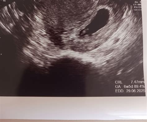 ultrazvuk embrya v 5. týždni tehotenstva