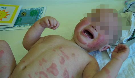 Dojča s atopickým ekzémom