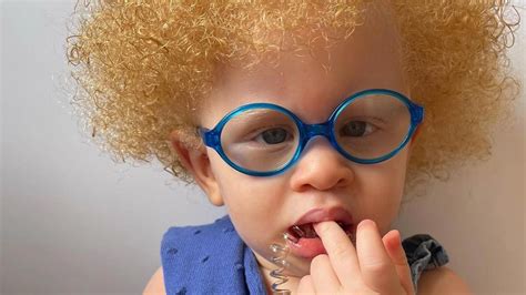 Dieťa s bledou pokožkou a unaveným výrazom