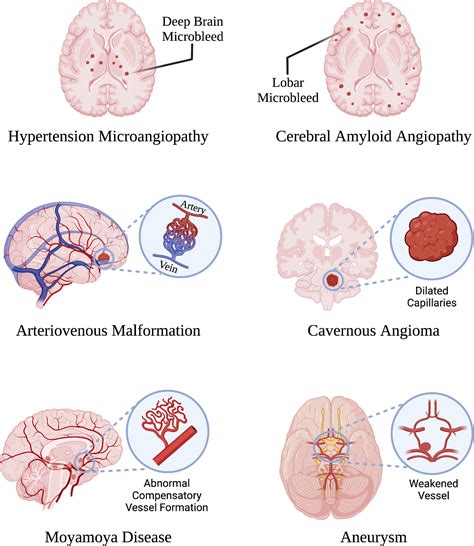 Diagram znázorňujúci chromozómy a ich abnormality