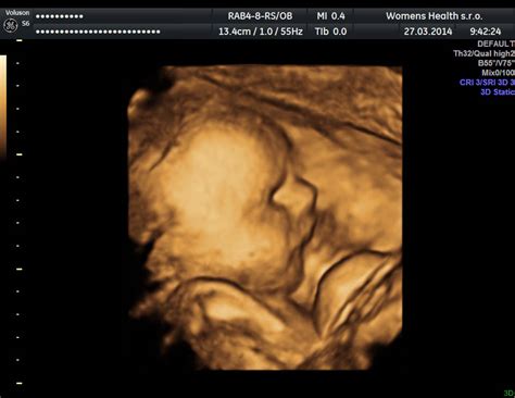 4D ultrazvukové zobrazenie dieťaťa v lone matky
