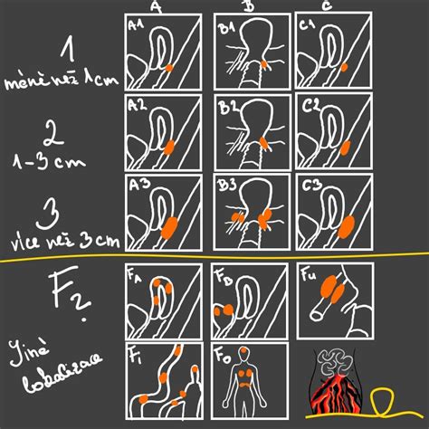 Ilustrácia endometriózy