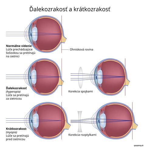 Diagram vysvetľujúci krátkozrakosť a ďalekozrakosť