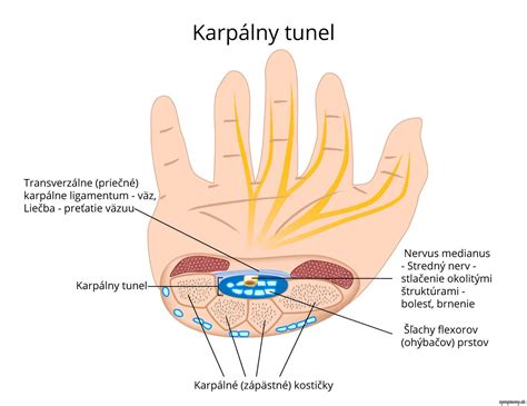 Diagram znázorňujúci karpálny tunel a jeho kompresiu