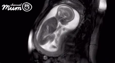 Dieťa v maternici počúva zvuky