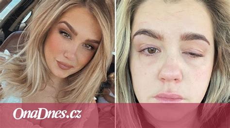 Žena oddychujúca doma po zákroku