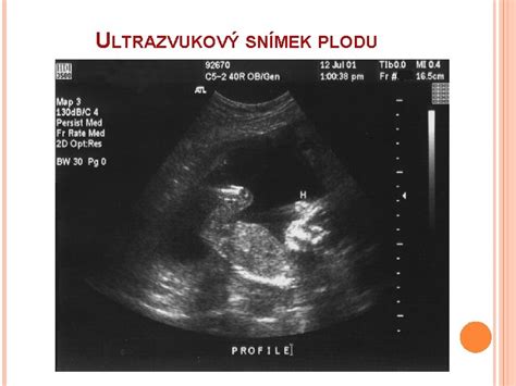 Ultrazvukový snímok plodu v druhom trimestri