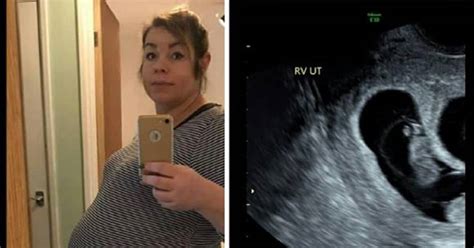 Ultrazvukový snímok dvojcievneho pupočníka