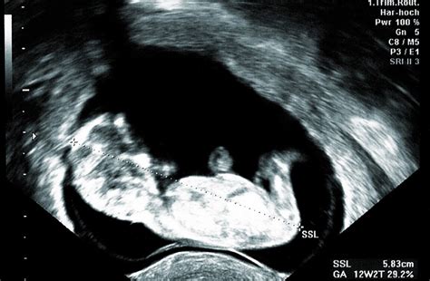 Plod v 12. týždni tehotenstva