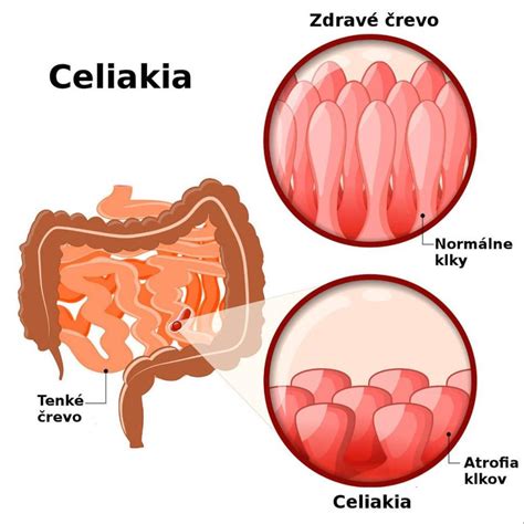 Schematické znázornenie vzniku žlčníkových kameňov