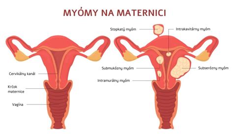 Implantácia blastocysty v maternici