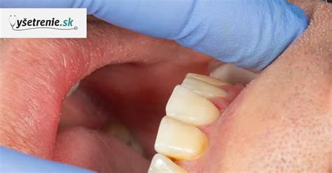 Porovnanie zubného povlaku a zubného kameňa