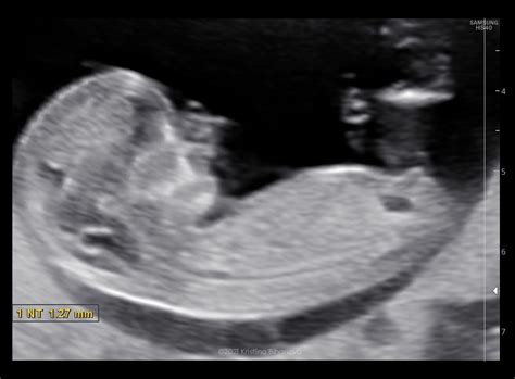 ultrazvukové vyšetrenie prvý trimester