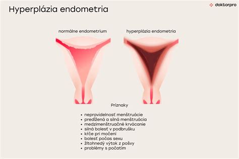 Infografika znázorňujúca priebeh liečby hyperplázie endometria