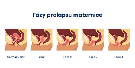 Infografika zobrazujúca rôzne štádiá prolapsu maternice