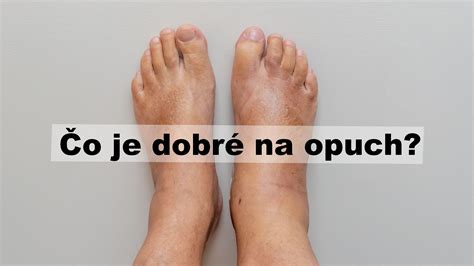 Infografika porovnávajúca bežný a nebezpečný opuch nohy