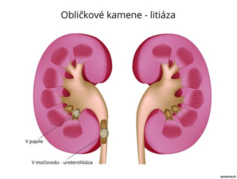 obličkové kamene