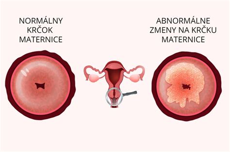 Ilustrácia krčka maternice počas tehotenstva