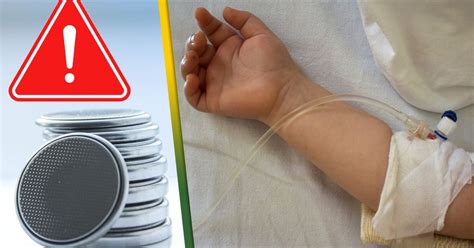 dieťa prehltlo gombíkovú batériu