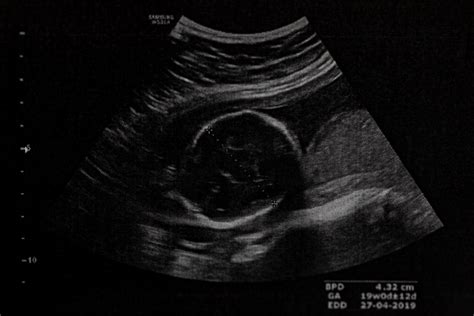 ultrazvuk plodu v maternici