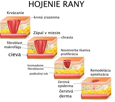Proces hojenia zlomeniny