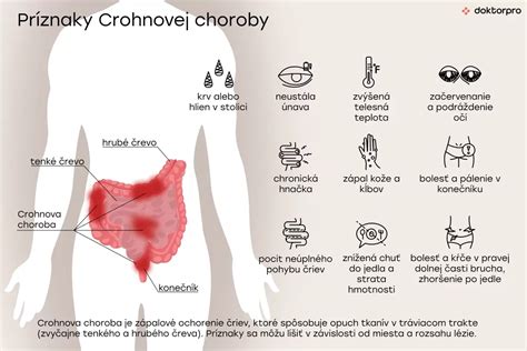 Infografika zobrazujúca možné komplikácie Crohnovej choroby