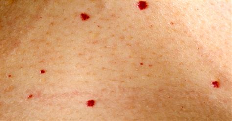 Ilustrácia rôznych typov červených bodiek na koži