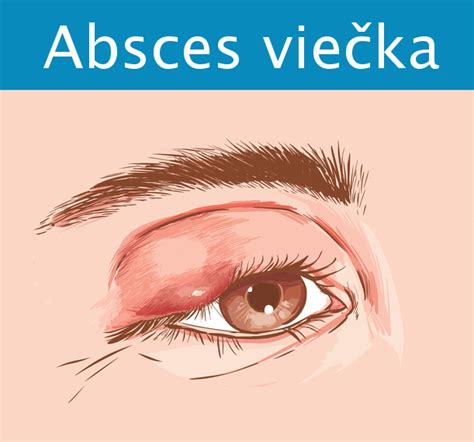 Ilustrácia ekzému na očnom viečku