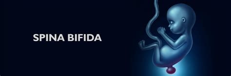 Ilustrácia rázštepu chrbtice (Spina Bifida)