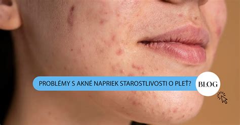 infografika o starostlivosti o pleť s akné