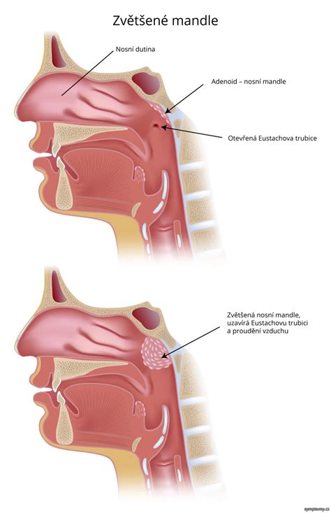schematické znázornenie zväčšených nosohltanových mandlí