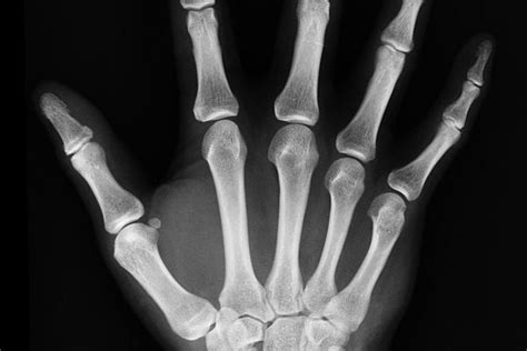 detský röntgenový snímok