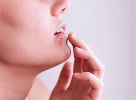 Ilustrácia liečebných postupov pre genitálny herpes