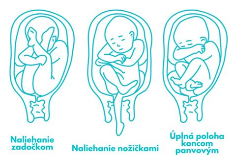 Schematické znázornenie polohy plodu koncom panvovým