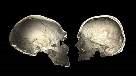 Diagram porovnávajúci normálne rastúcu lebku s lebkou postihnutou kraniostenózou