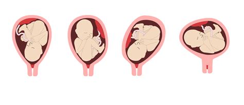 diagram zobrazujúci rôzne polohy plodu v maternici